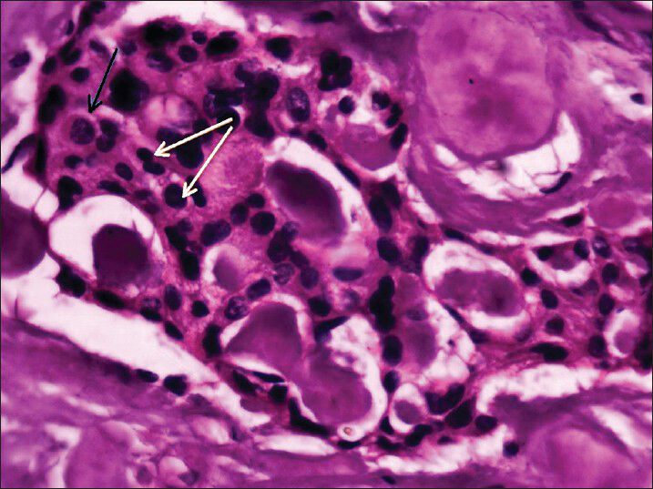 38-year-old female patient with a huge swelling on the right side of the face diagnosed with calcifying epithelial odontogenic tumor. Hematoxylin and eosin-stained biopsy section shows polygonal squamous epithelial cells exhibiting distinct intercellular bridges (black arrow) along with cellular and nuclear polymorphism (white arrows), and areas of irregular calcification and eosinophilic material.